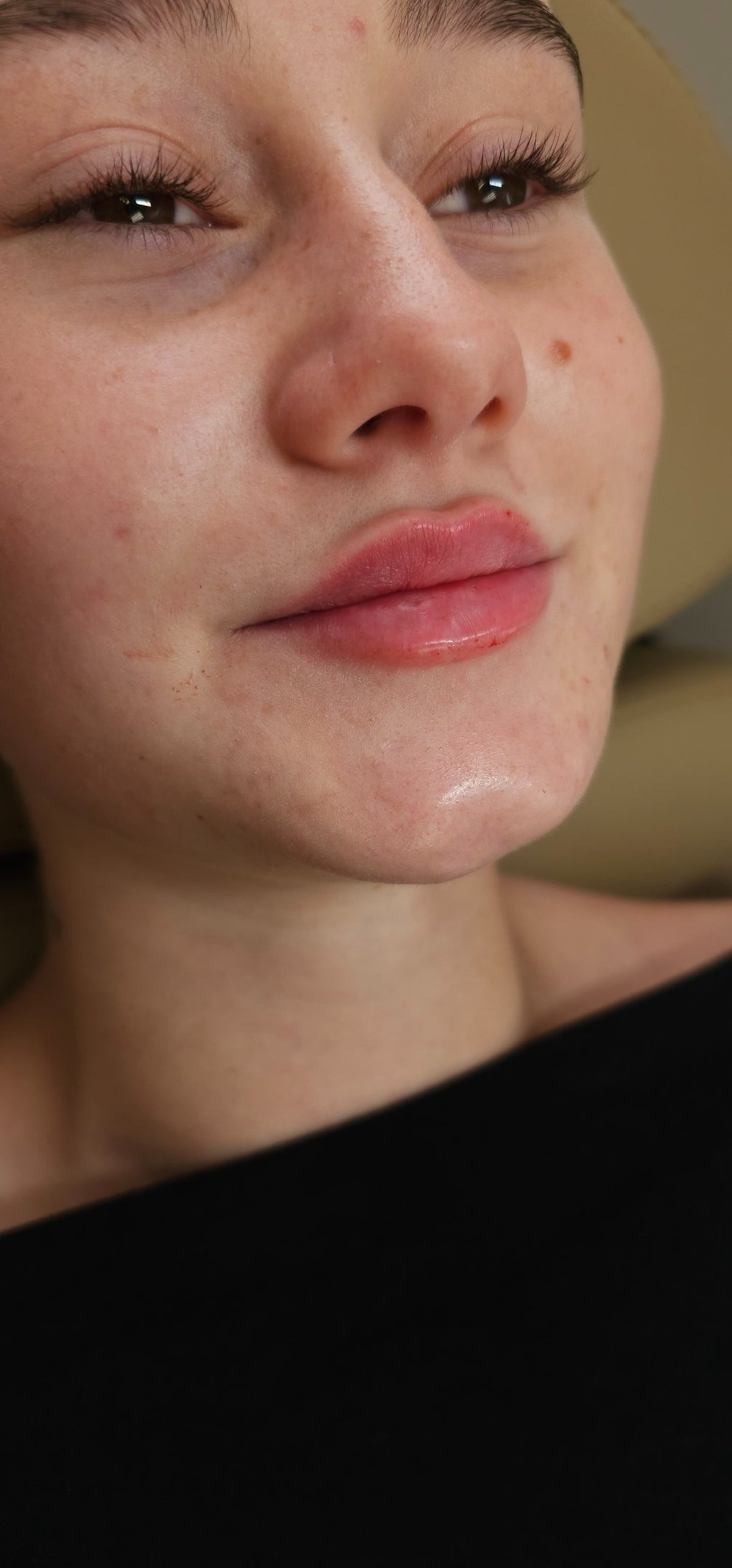 Lip enhancement results by Celeste at Little Red Esthetics