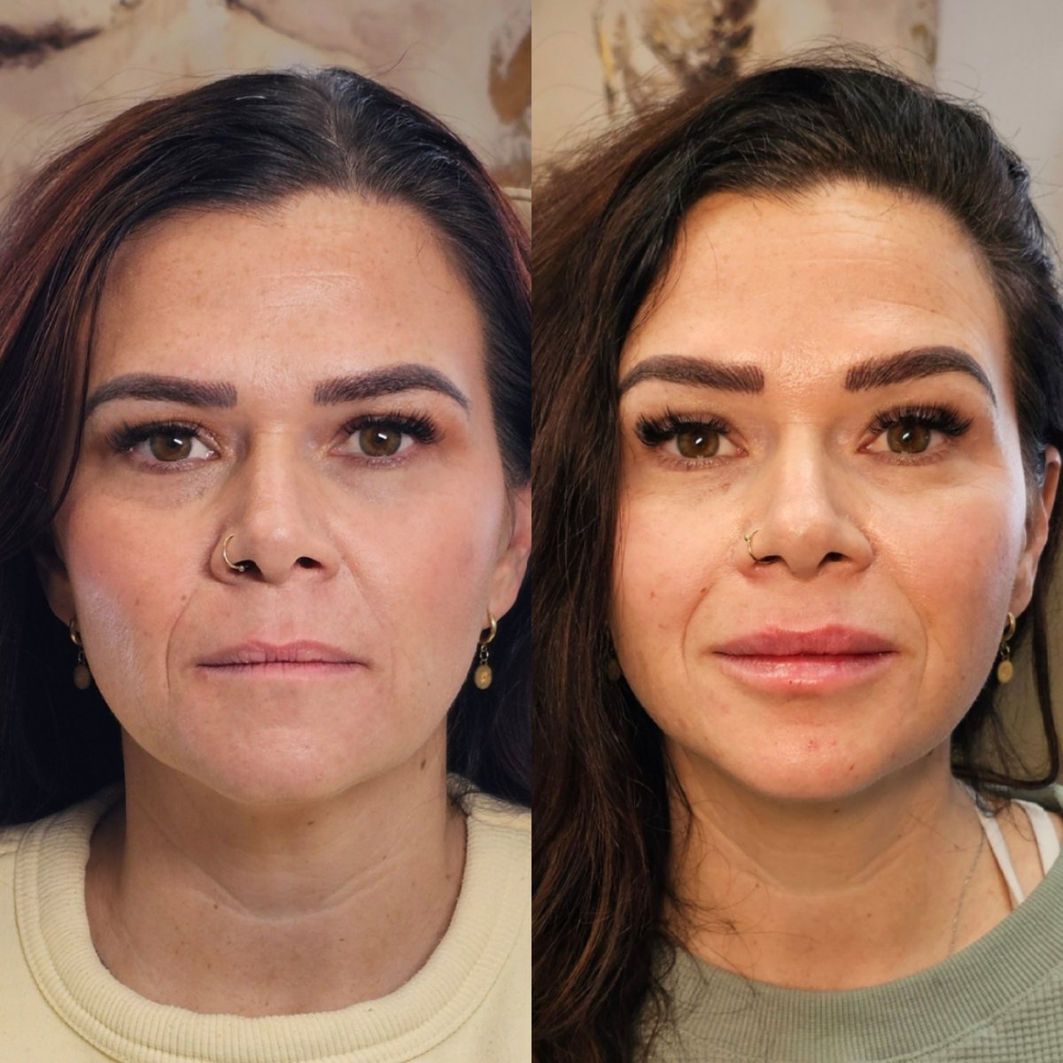 Neuromodulator treatment results by Little Red Esthetics