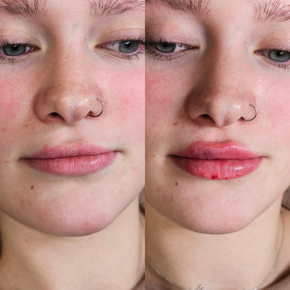 Aesthetic treatment results by Little Red Esthetics
