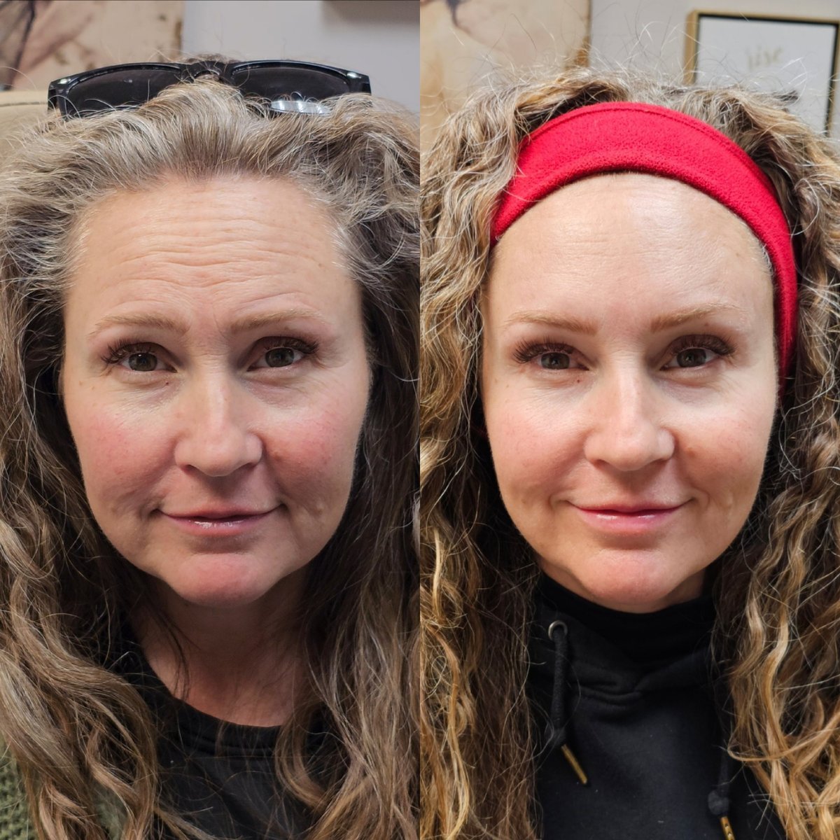 Dermal filler results by Little Red Esthetics